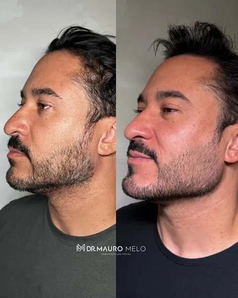 Antes e depois de harmonização Full Face masculina com contorno e projeção, vista de perfil