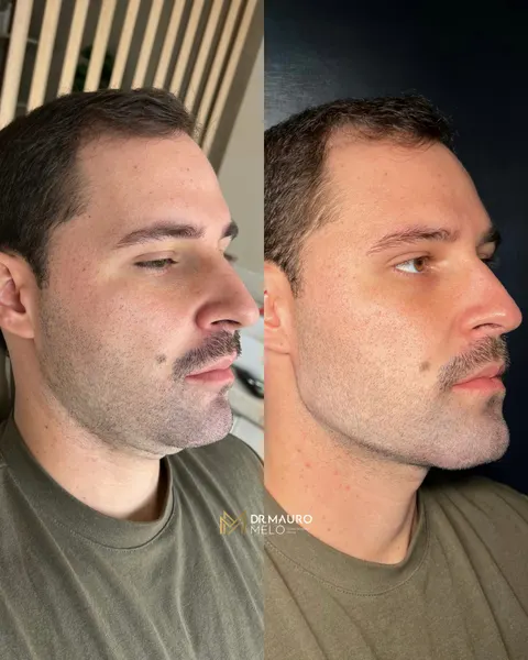 Antes e depois de harmonização Full Face masculina, segundo ângulo