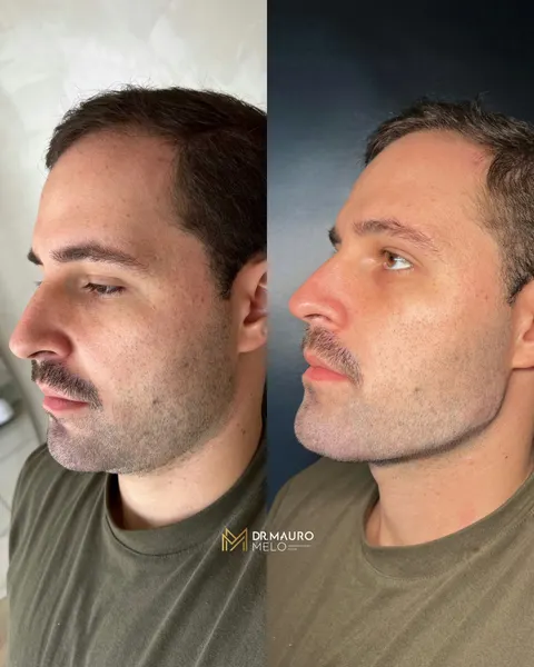 Caso de harmonização Full Face masculina, antes e depois