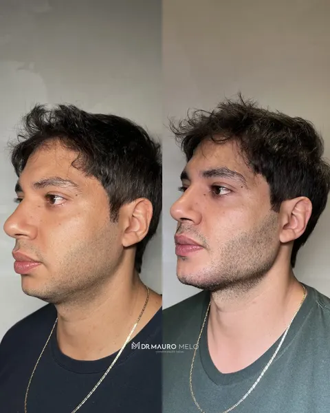 Antes e depois de definição de mandíbula e perfil masculino