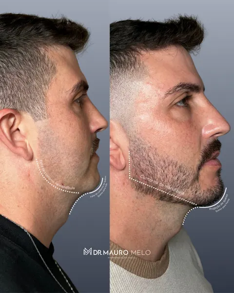 Caso de contorno de mandíbula e projeção de queixo em paciente homem, antes e depois