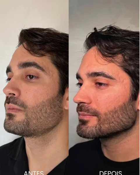Antes e depois do método Full Face masculino, vista de três quartos