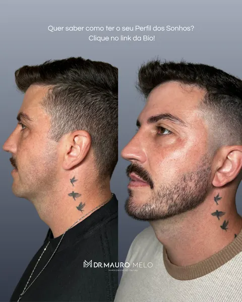 Caso de harmonização do perfil masculino, antes e depois
