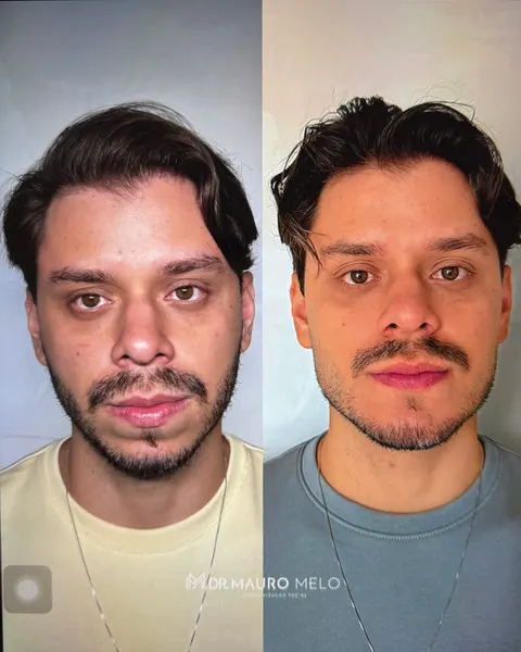 Antes e depois de projeção de queixo e mandíbula em paciente jovem, vista frontal