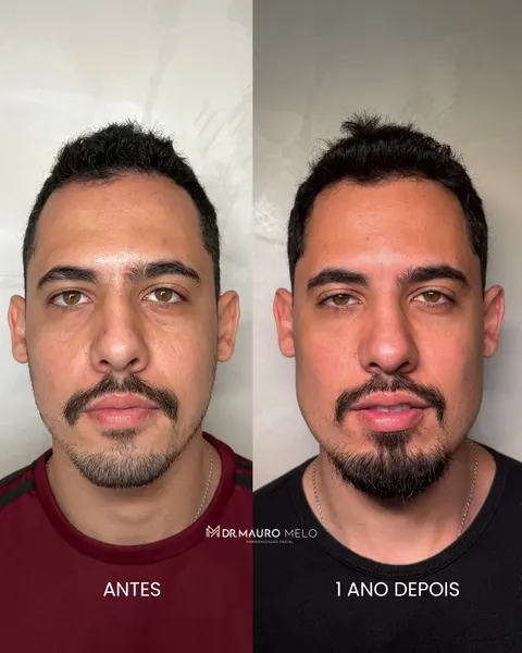 Antes e 1 ano depois de harmonização facial masculina, vista frontal